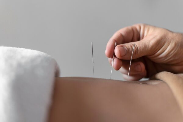 Aiguilles d'acupuncture sur le dos d'un patient